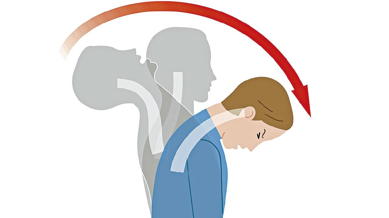 最常見頸椎外傷：馬鞭式創傷