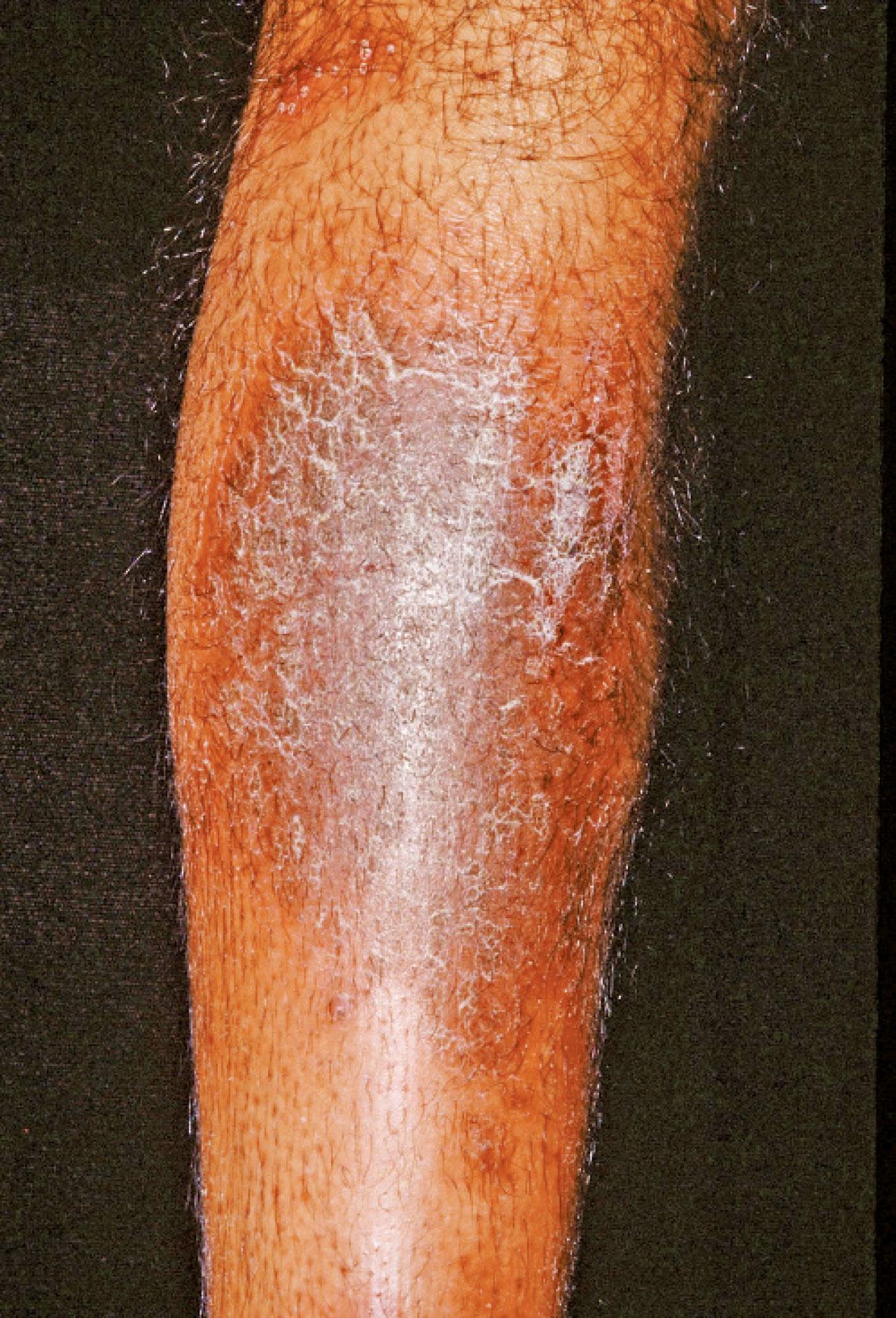 為何牛皮癬容易被混淆？