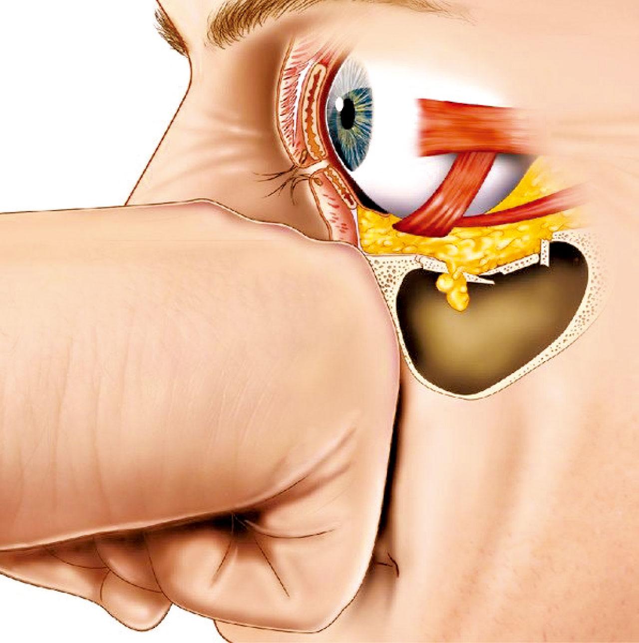 眼窩骨折的治療和手術