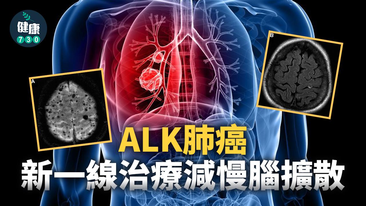 ALK肺癌 新一線治療減慢腦擴散