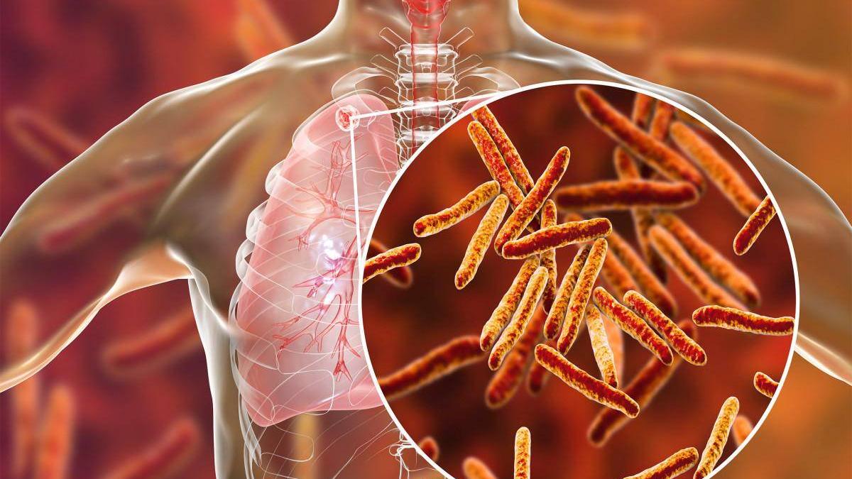 上半年學校呈報結核病1577宗　有專上院校現群組個案