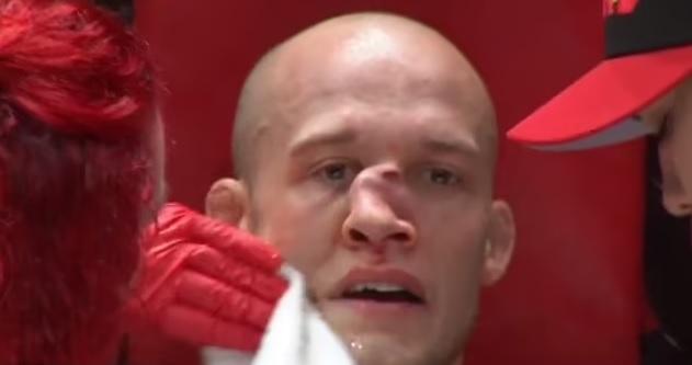 佩里被對手膝撞，致鼻樑扭曲。(互聯網)