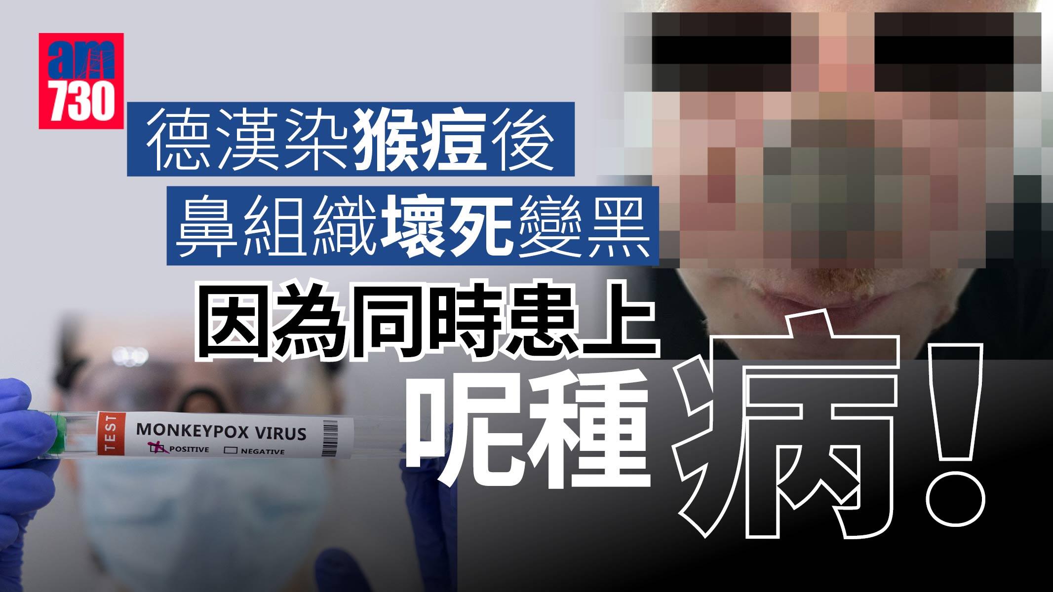 猴痘｜德漢染猴痘後鼻組織壞死變黑-原來因為患上呢種病