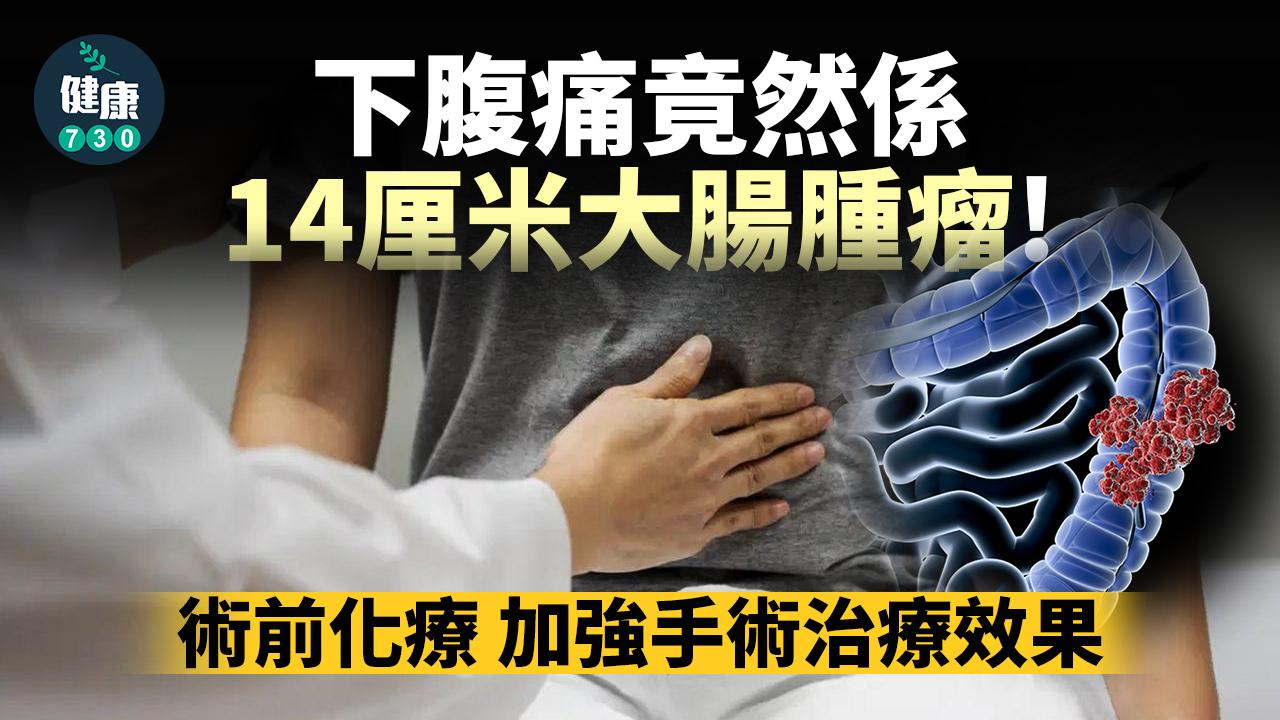 下腹痛竟然係14厘米大腸腫瘤！先化療後手術成功切除