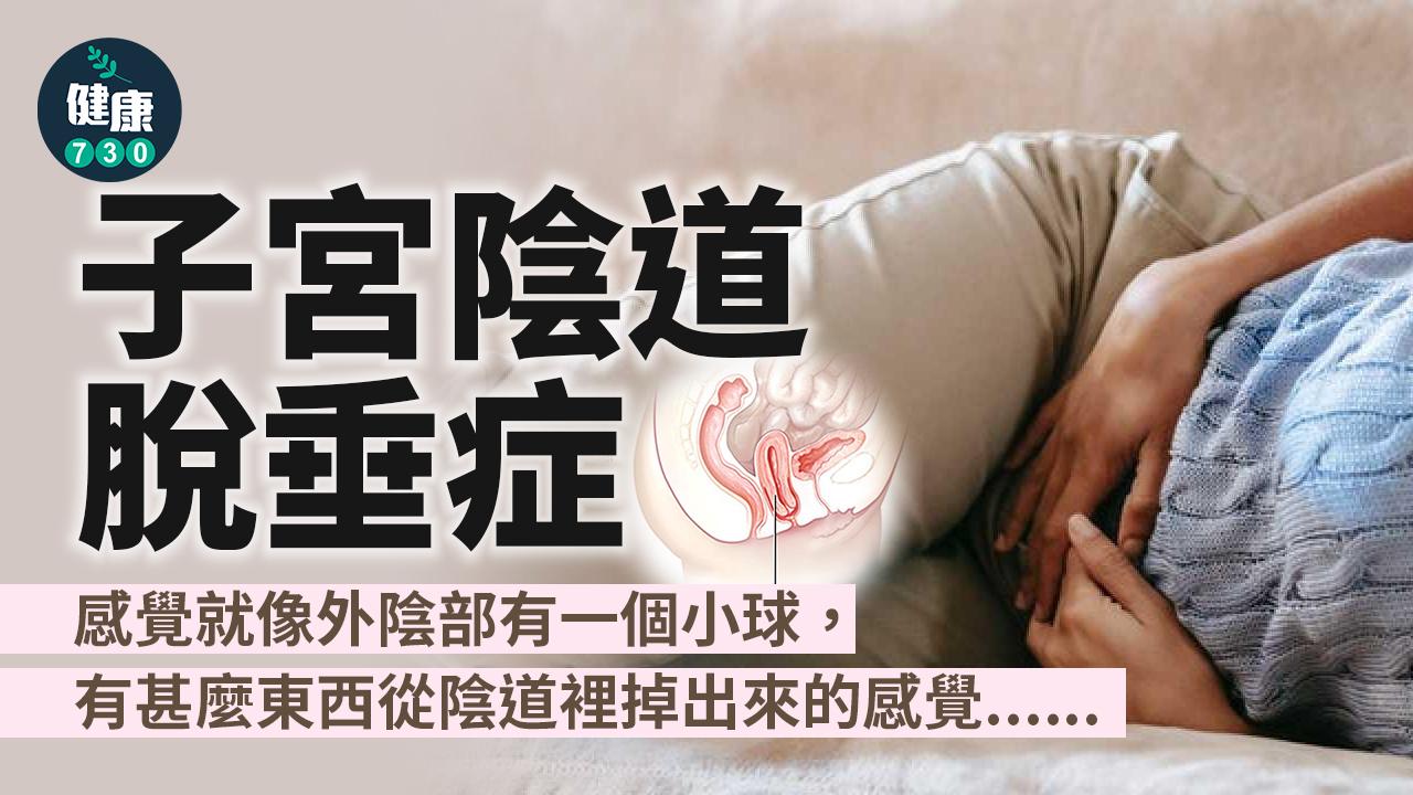女士難言之隱 子宮陰道脫垂症