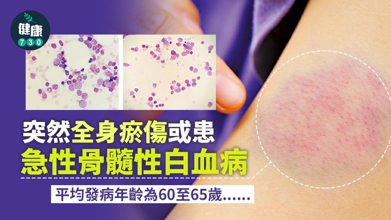 突然全身瘀傷或患AML
