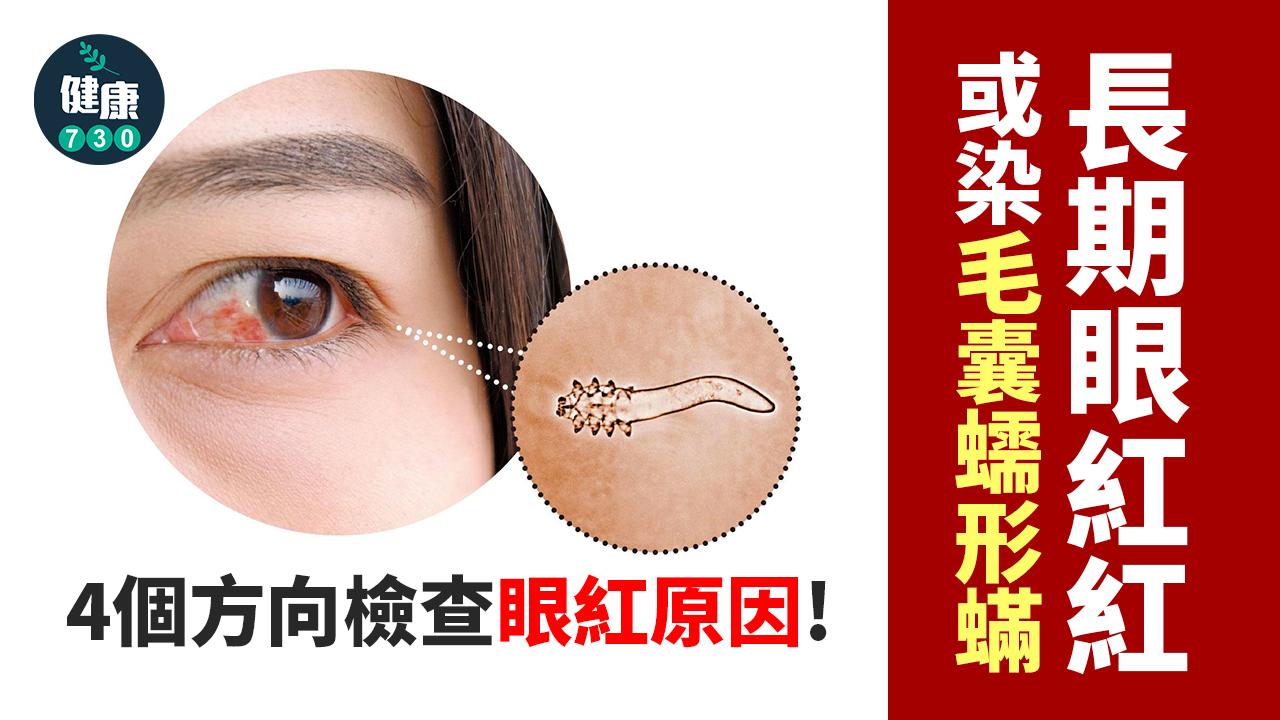 長期眼紅紅 或染毛囊蠕形蟎