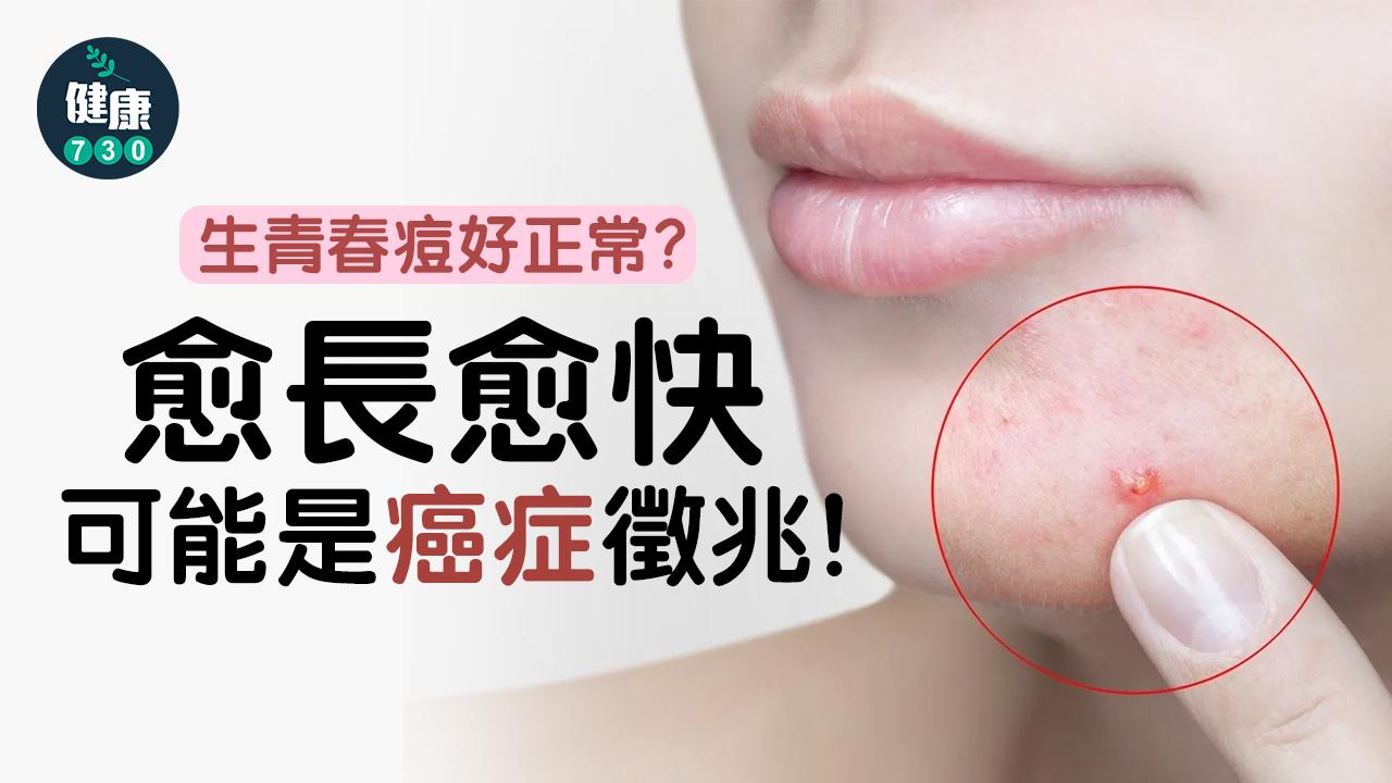 青春痘好正常？未好又變大小心皮膚癌