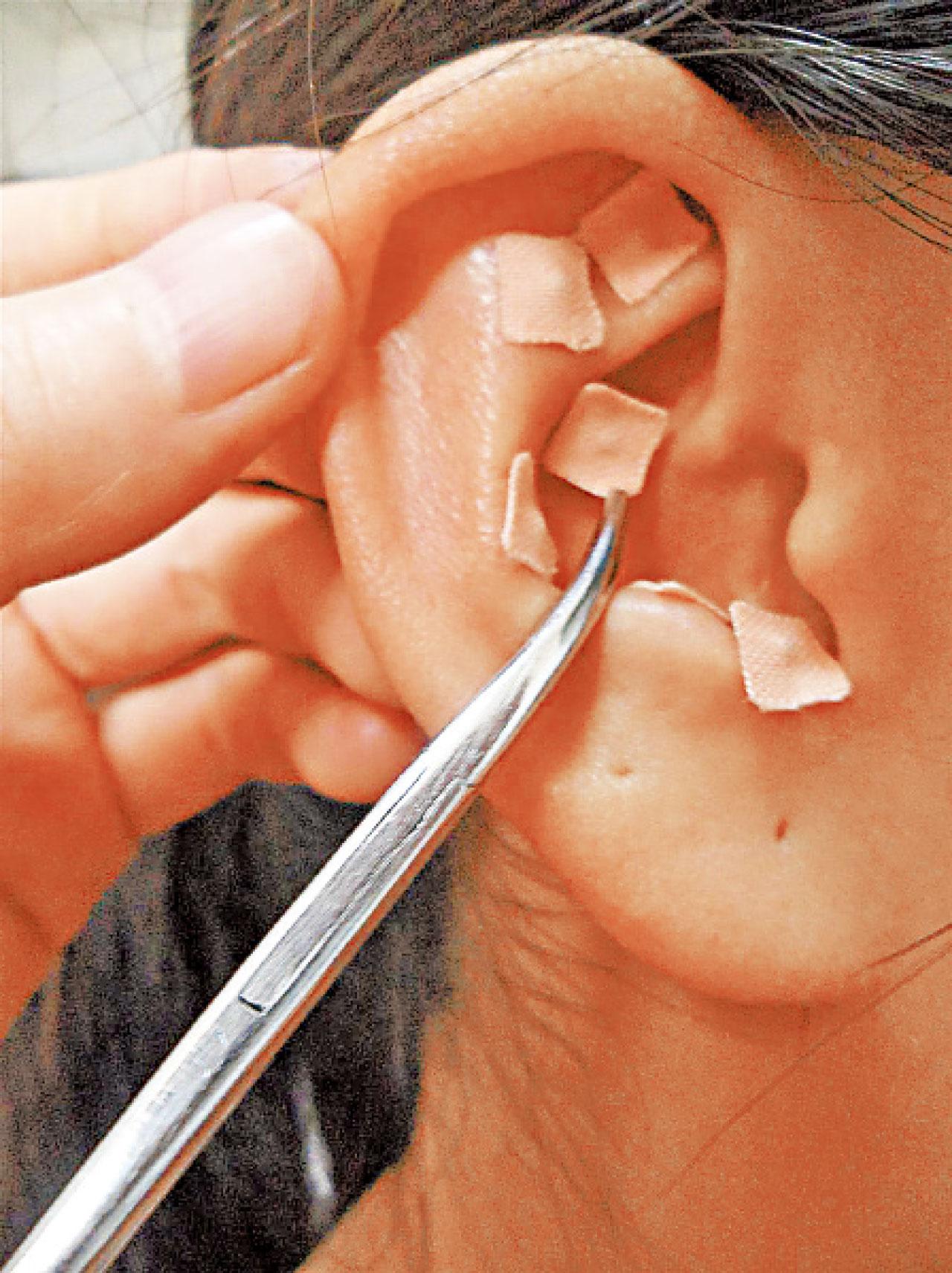 中醫特色療法——耳穴療法