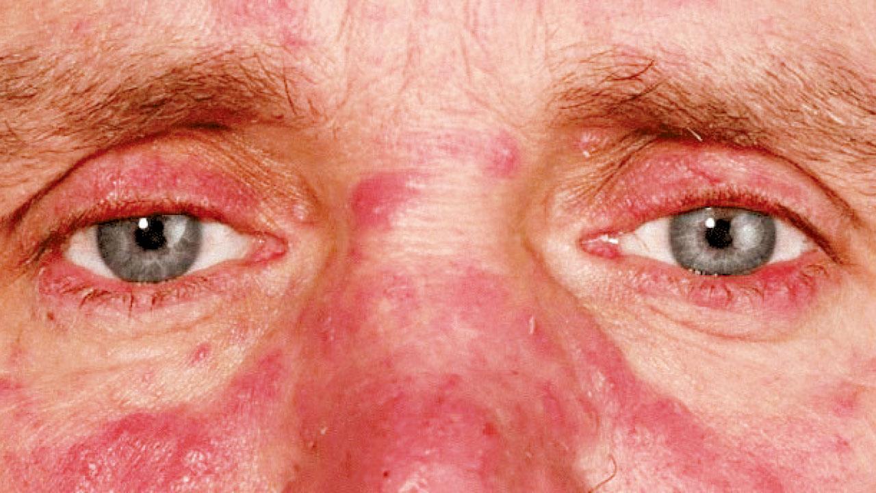 玫瑰痤瘡 影響眼睛