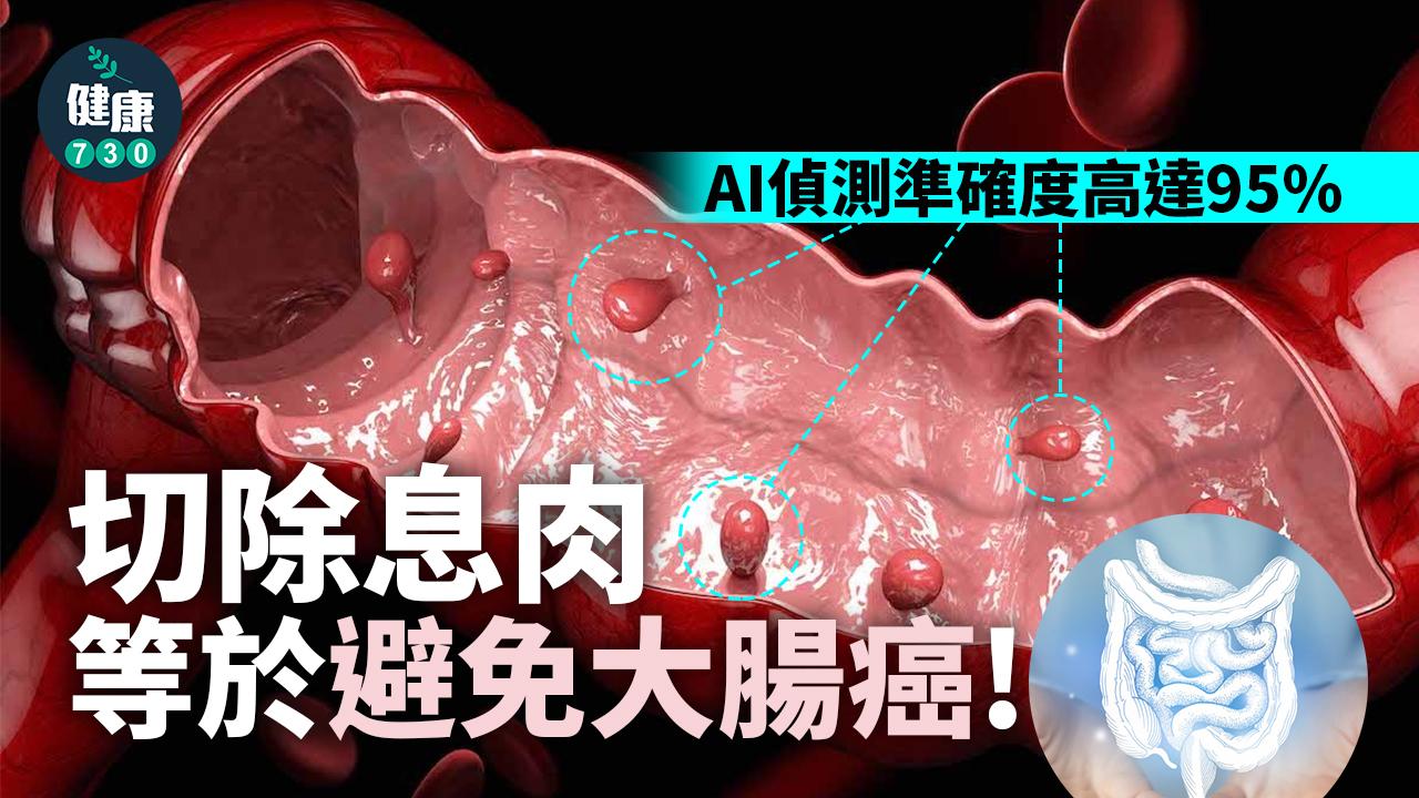 AI偵測大腸息肉 準確率高達95% 有效降低大腸癌發生率