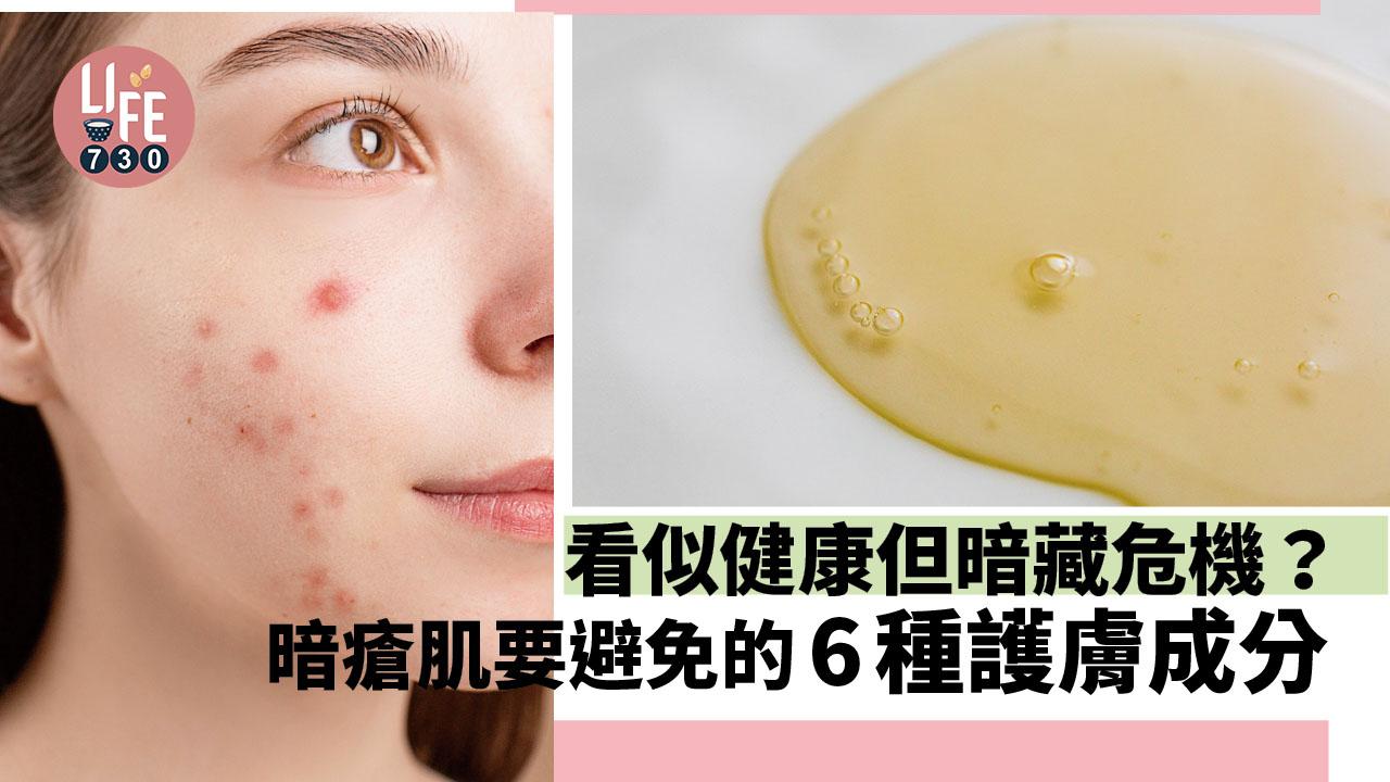 看似天然健康但暗藏危機？暗瘡肌膚要避免的6種護膚成分