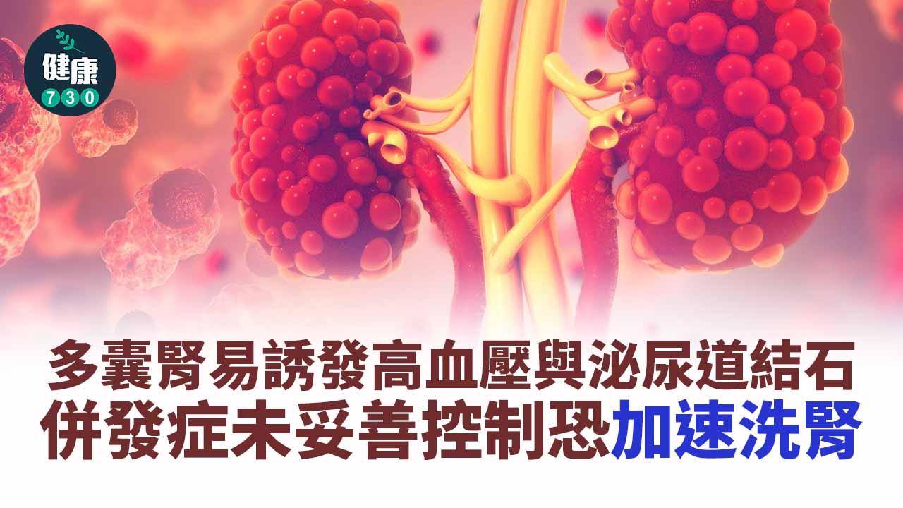 多囊腎易誘發高血壓與泌尿道結石 併發症未妥善控制恐加速洗腎