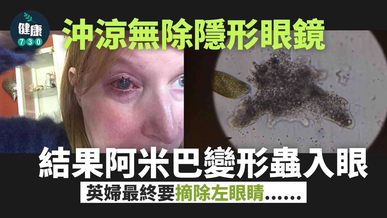 恐怖醫學｜沖涼無除隱形眼鏡 英婦失去一隻眼