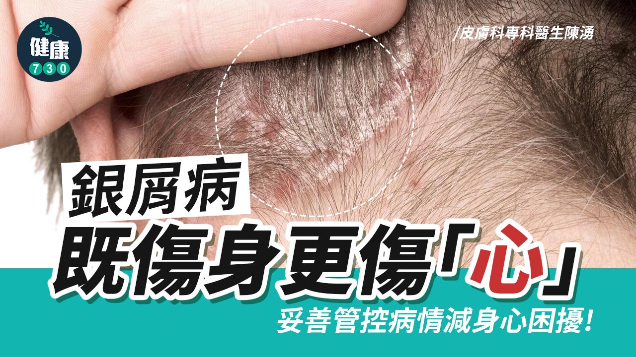 銀屑病既傷身更傷「心」 妥善管控病情減身心困擾