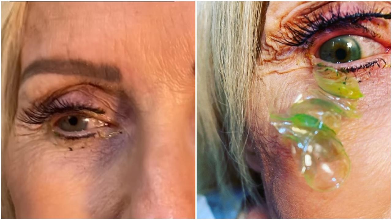 美婦連戴23副隱形眼鏡忘記除，部分已變成綠色。(IG)