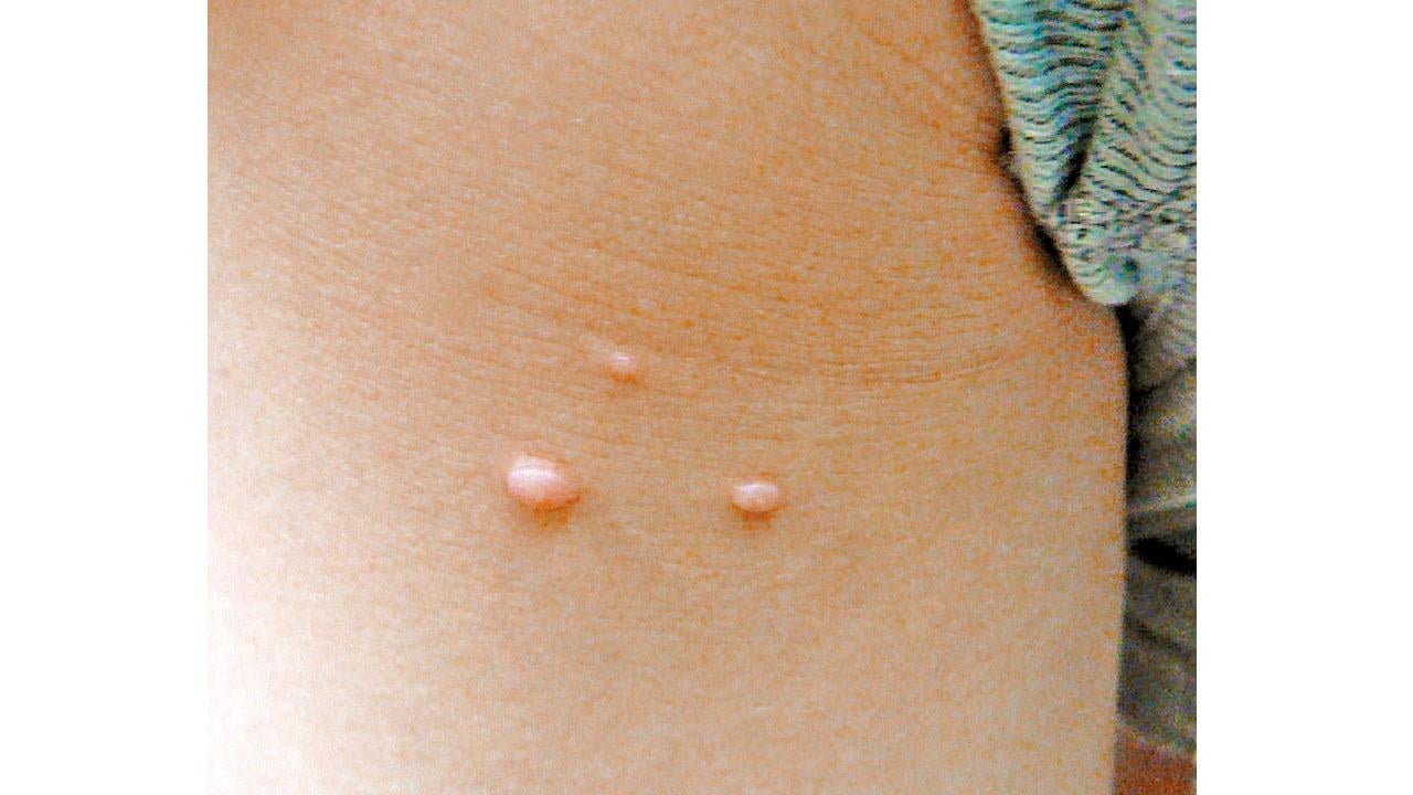 扁平疣和珍珠疣的分別