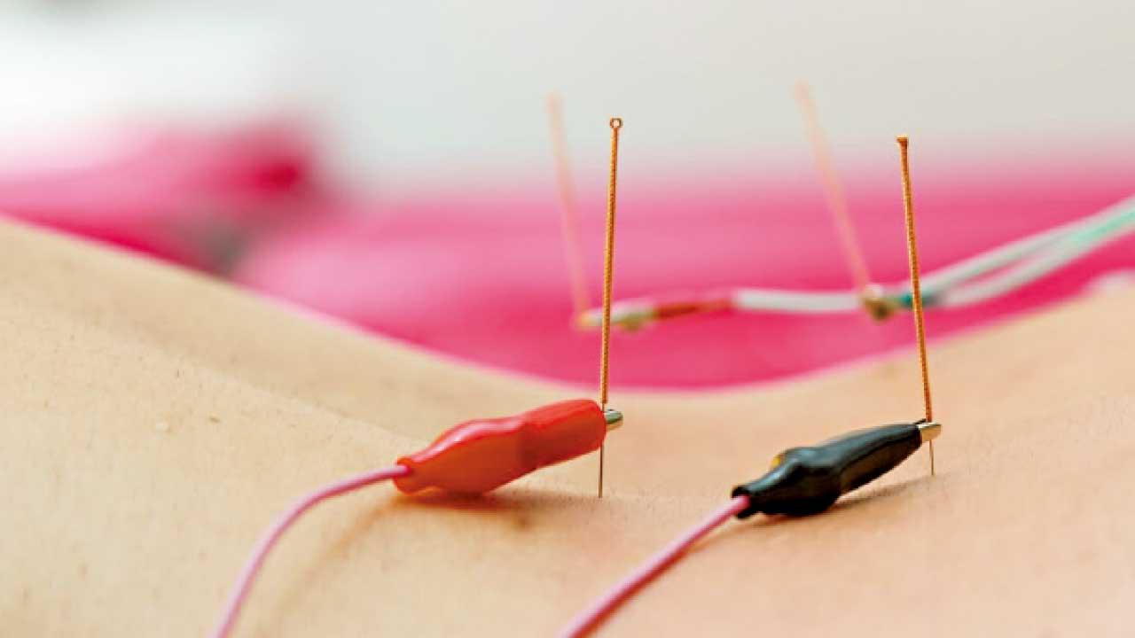 針刺加電針治療慢性腰背痛