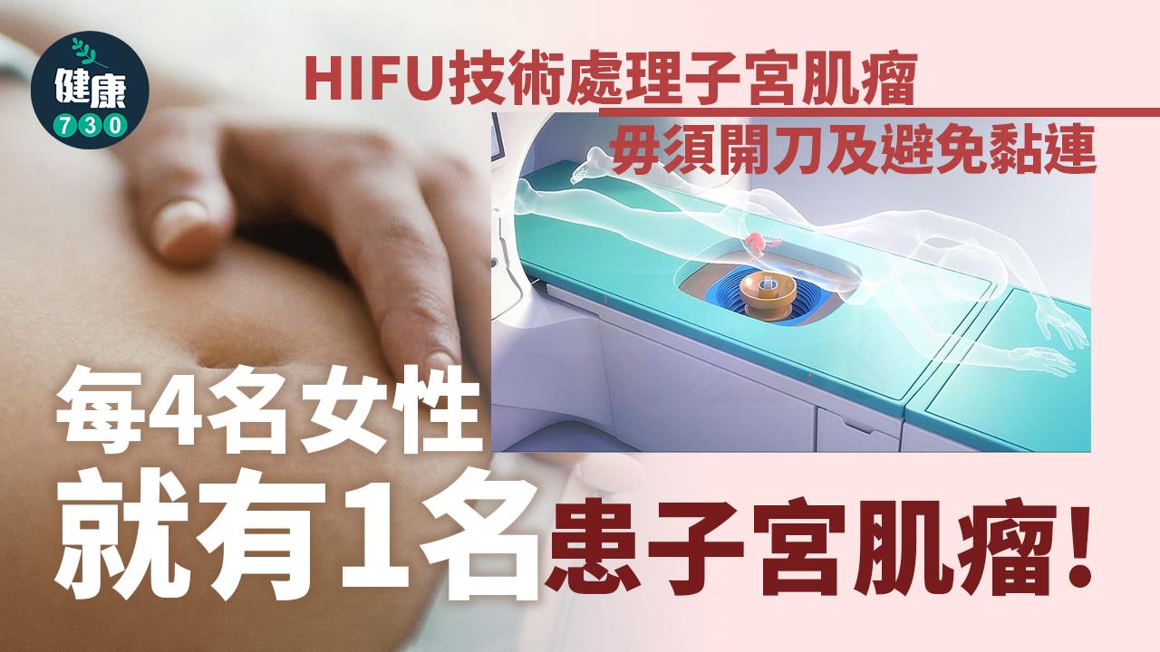 HIFU免開刀 治療子宮肌瘤