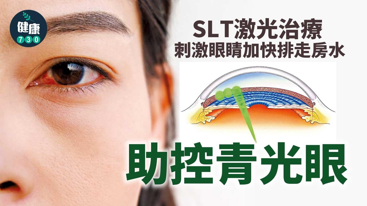 SLT激光治療 助控青光眼