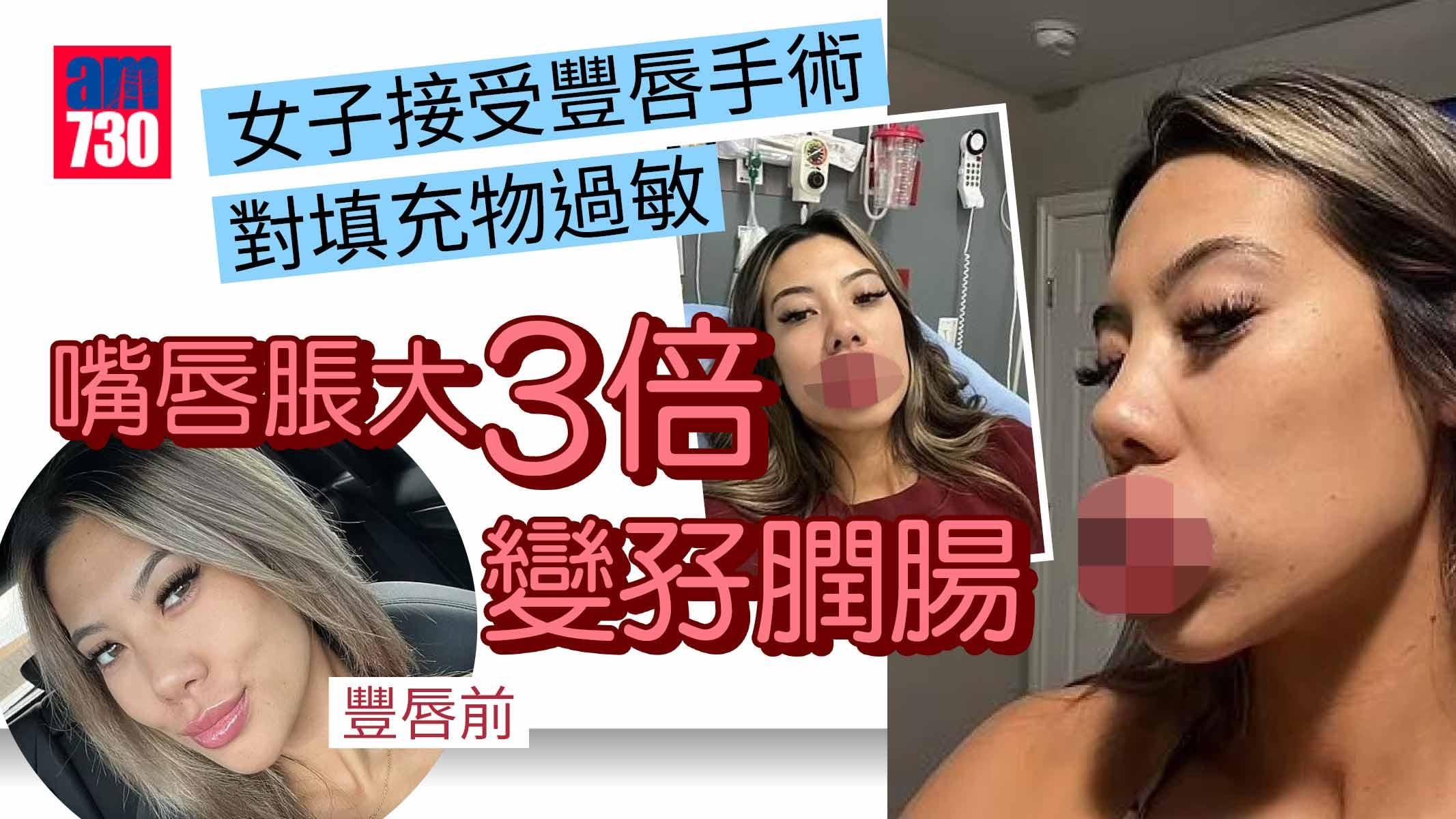 女子豐唇對填充物過敏 脹至3倍變「孖膶腸」