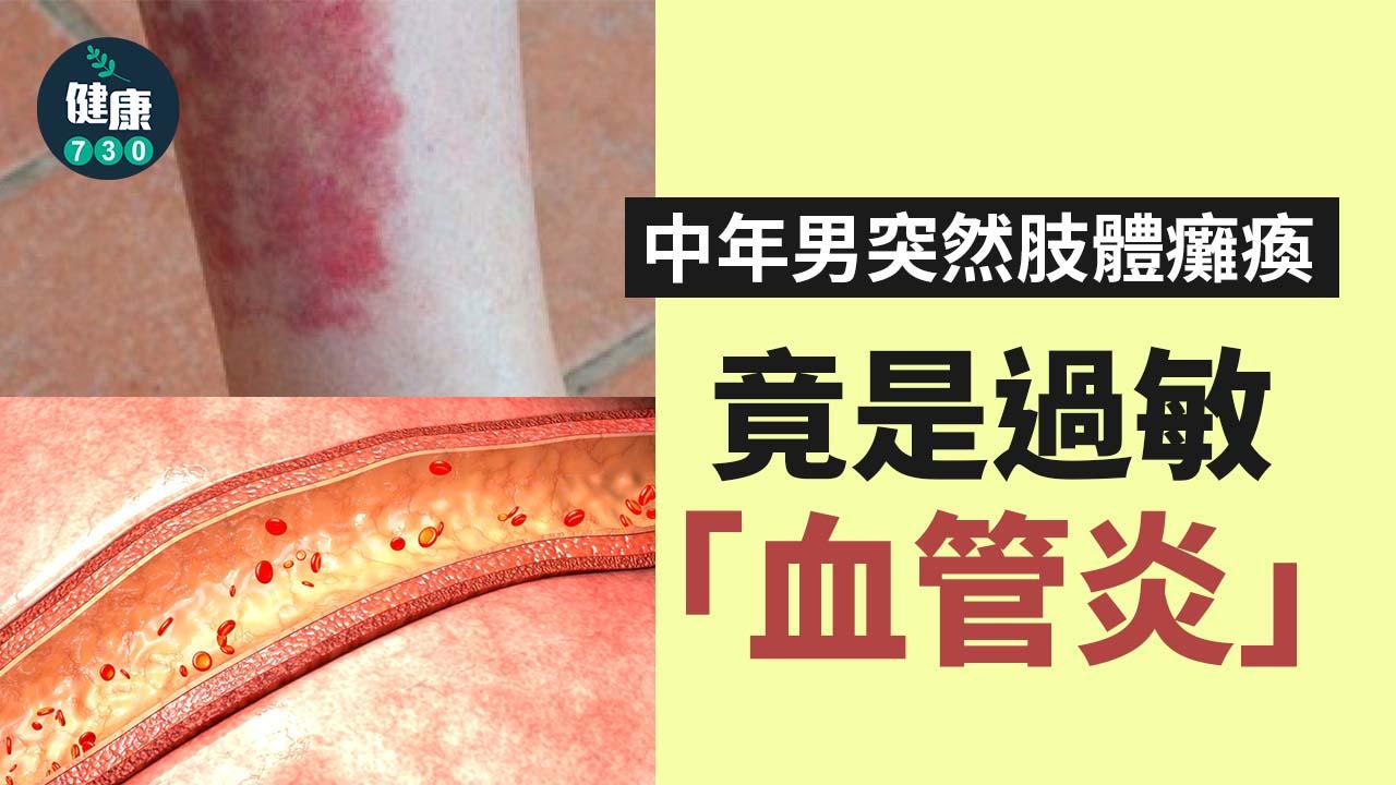 中年男突然肢體癱瘓 竟是過敏「血管炎」