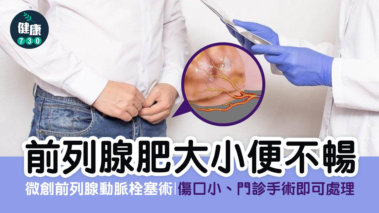 前列腺肥大｜前列腺肥大小便不暢 新微創手術門診可處理