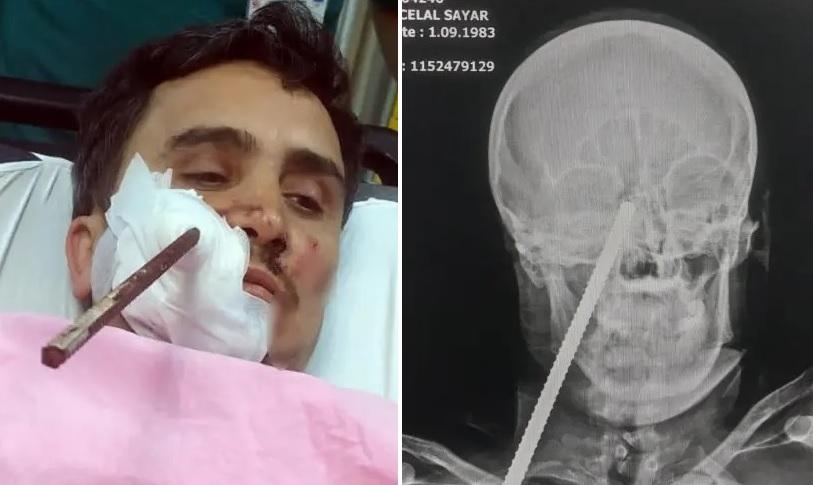 X光影像顯示，鋼筋貫穿薩亞爾眼眶下方位置，險些傷及腦部。(互聯網)