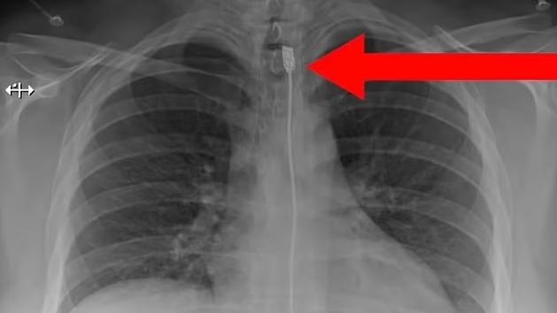 X光圖像顯示，充電接頭卡在上食道喉嚨位置。(互聯網)