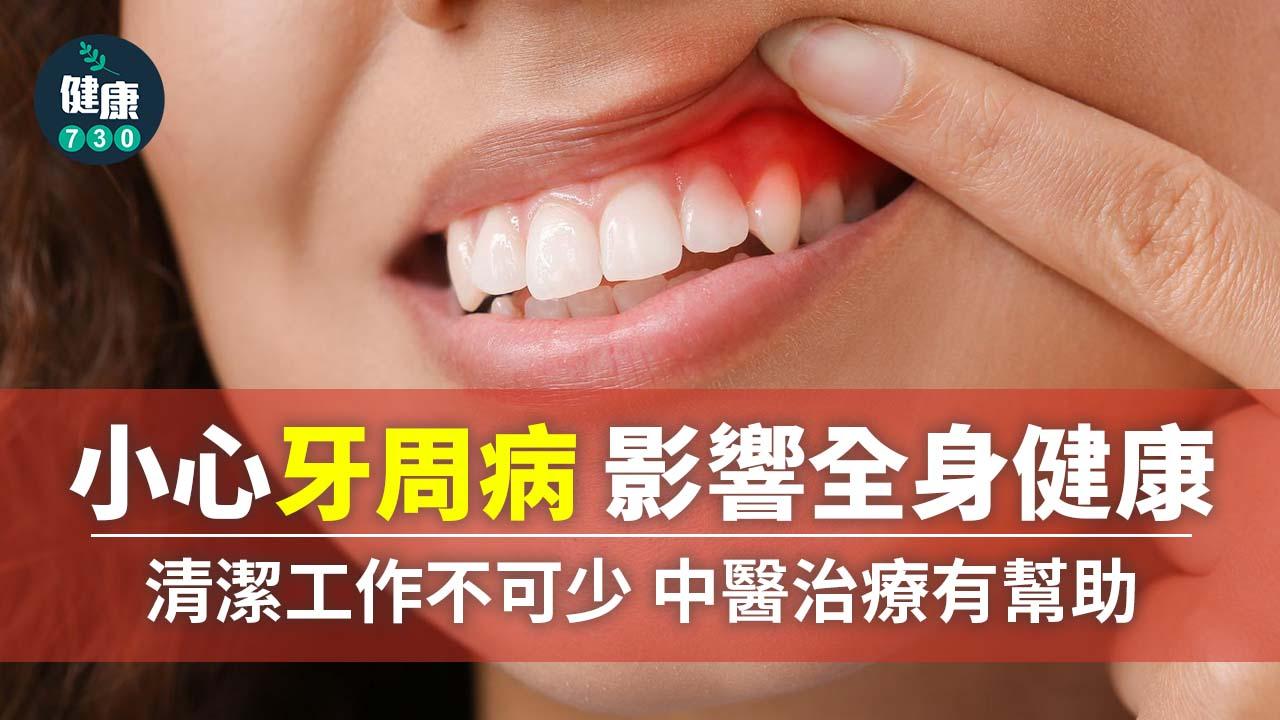 牙周病清潔工作不可少 中醫治療有幫助