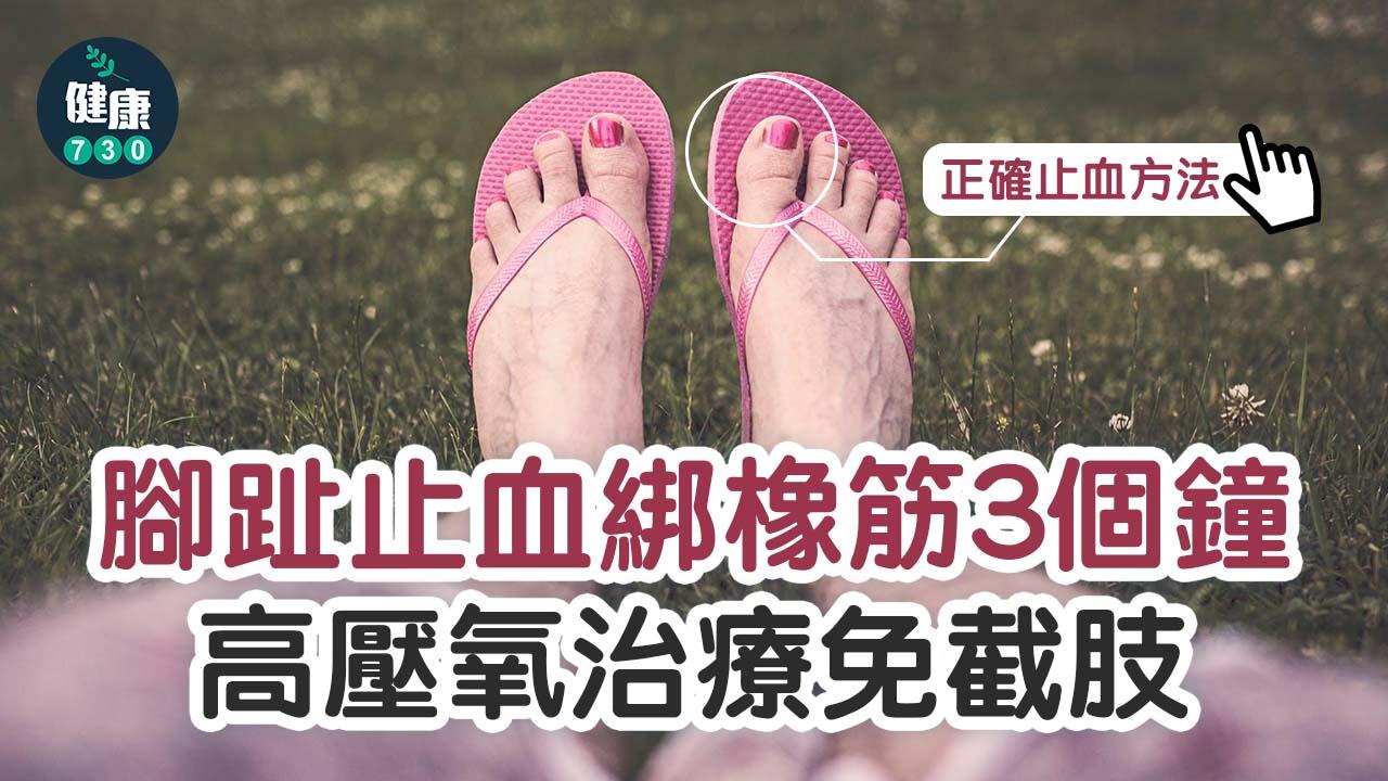 腳趾止血綁橡筋3個鐘 高壓氧治療免截肢