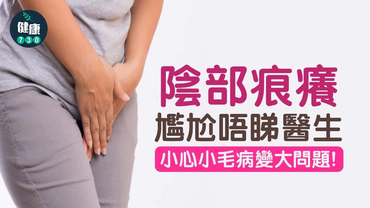 陰部痕癢尷尬唔睇醫生 小心小毛病變大問題