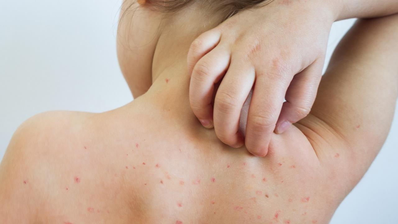 麻疹成「全球逼在眉睫威脅」，世衞及美國CDC發警示。(網上圖片)