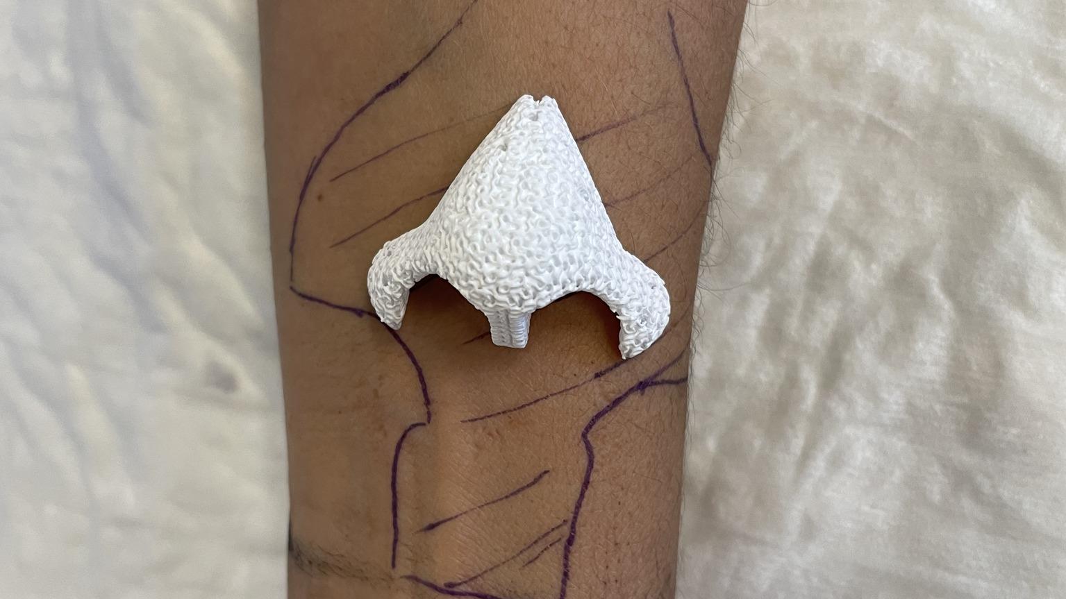 3D打印技術手臂長鼻超怪異，患鼻腔癌女病人鼻哥失而復得。(FB)