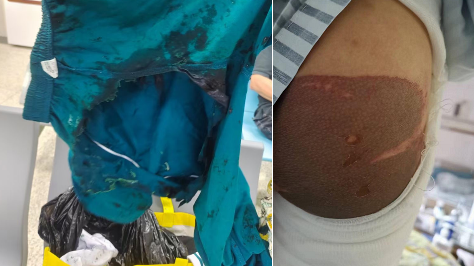 受害孩童褲子被硫酸腐蝕出一個大洞，皮膚嚴重灼傷。(互聯網)