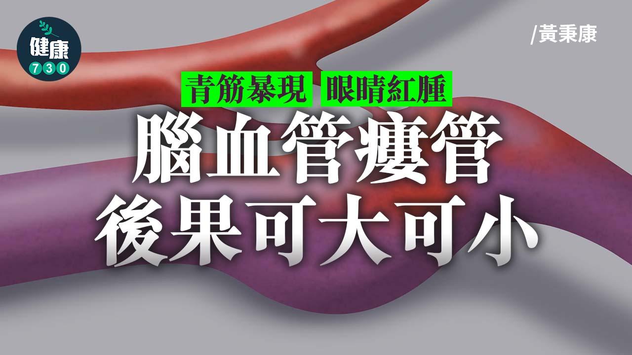 腦內亂擾的血管瘻管