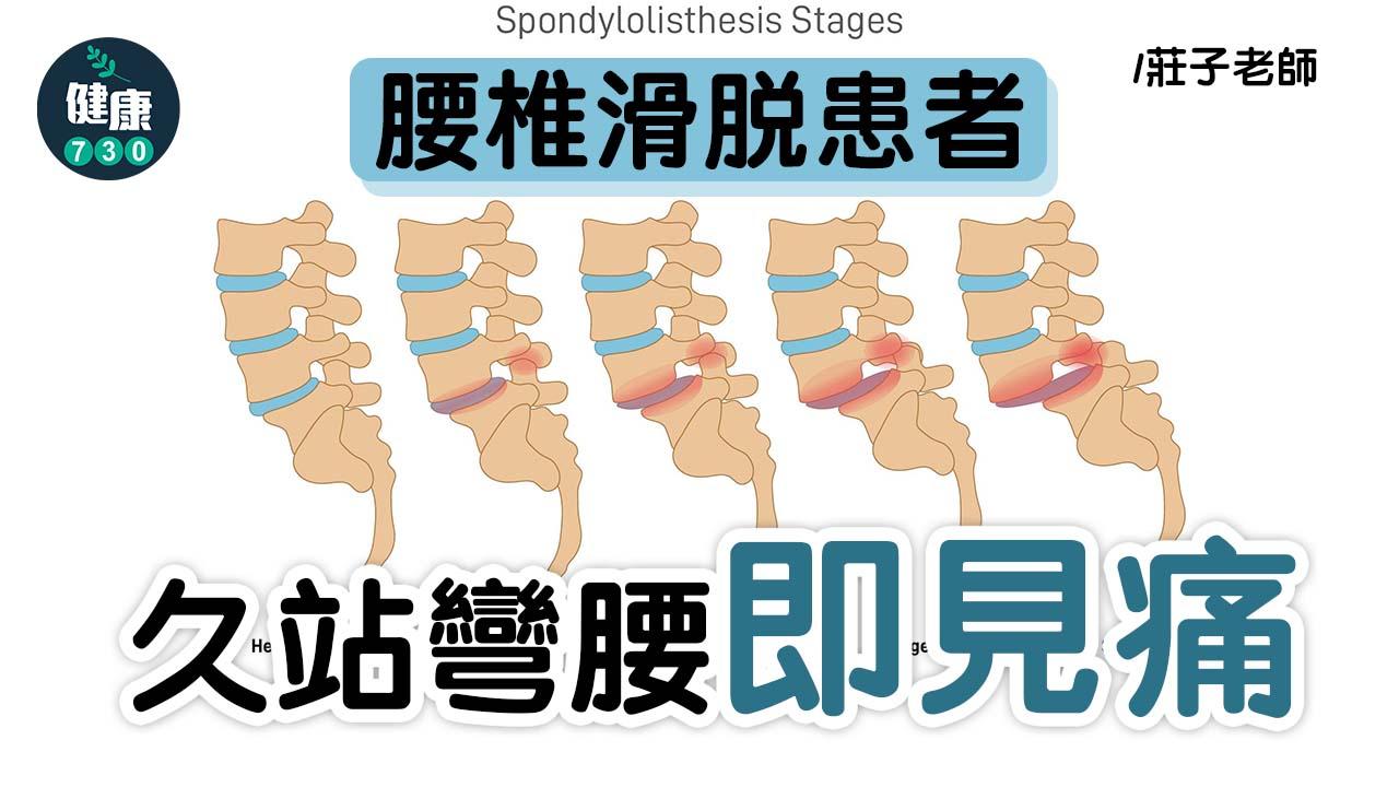 腰椎滑脫患者 久站彎腰即見痛