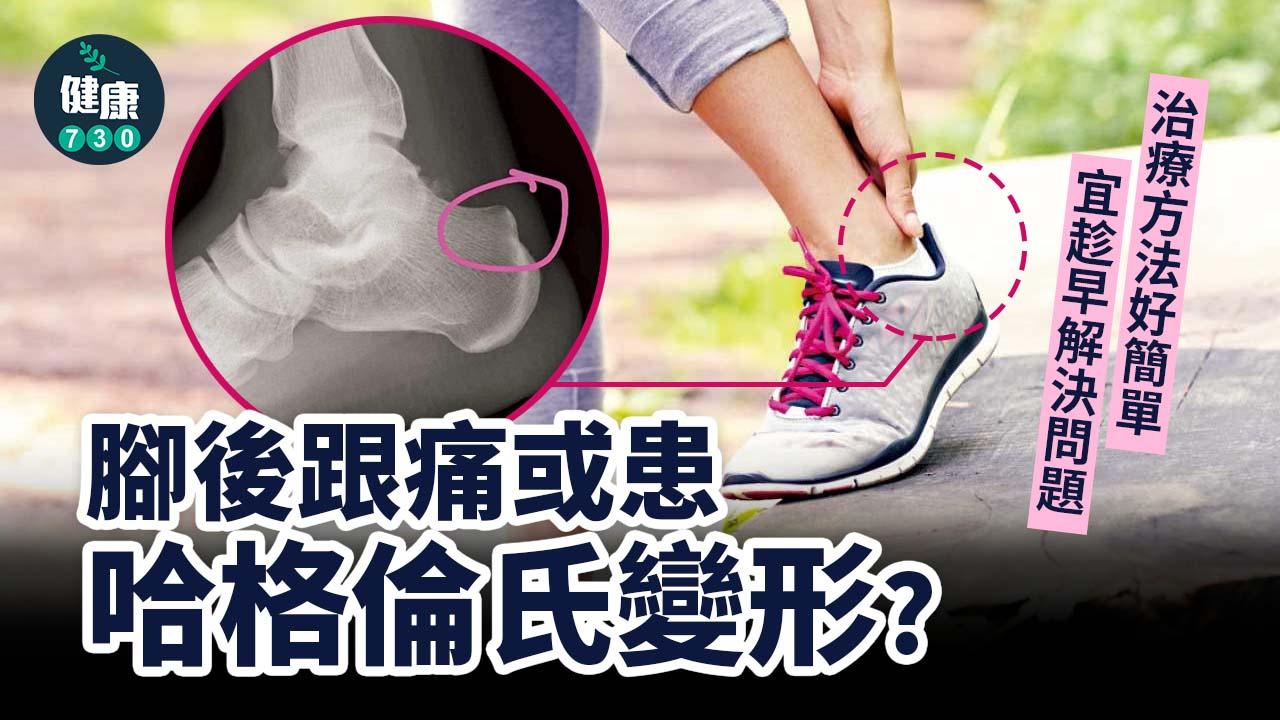 骨質增生｜腳後跟痛或患哈格倫氏變形？