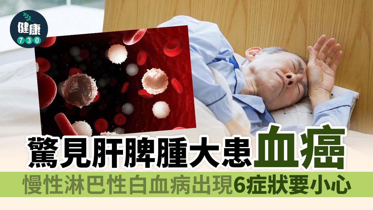 驚見肝脾腫大患血癌 慢性淋巴性白血病出現6症狀要小心