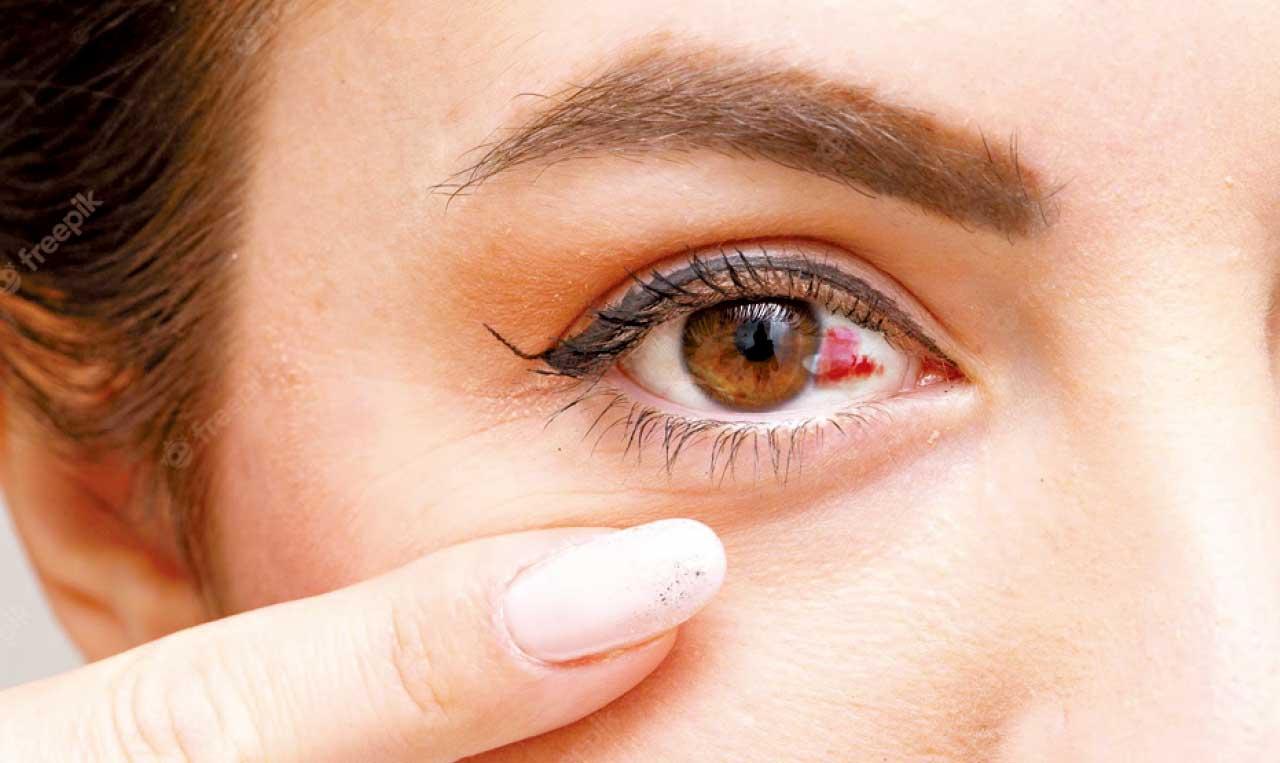 眼睛一片紅 結膜下出血