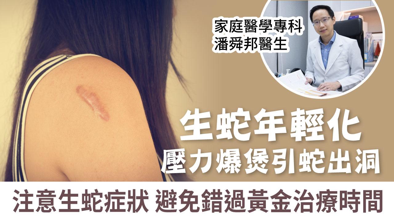 生蛇 | 生蛇年輕化 壓力爆煲引蛇出洞 注意生蛇症狀避免錯過黃金治療時間