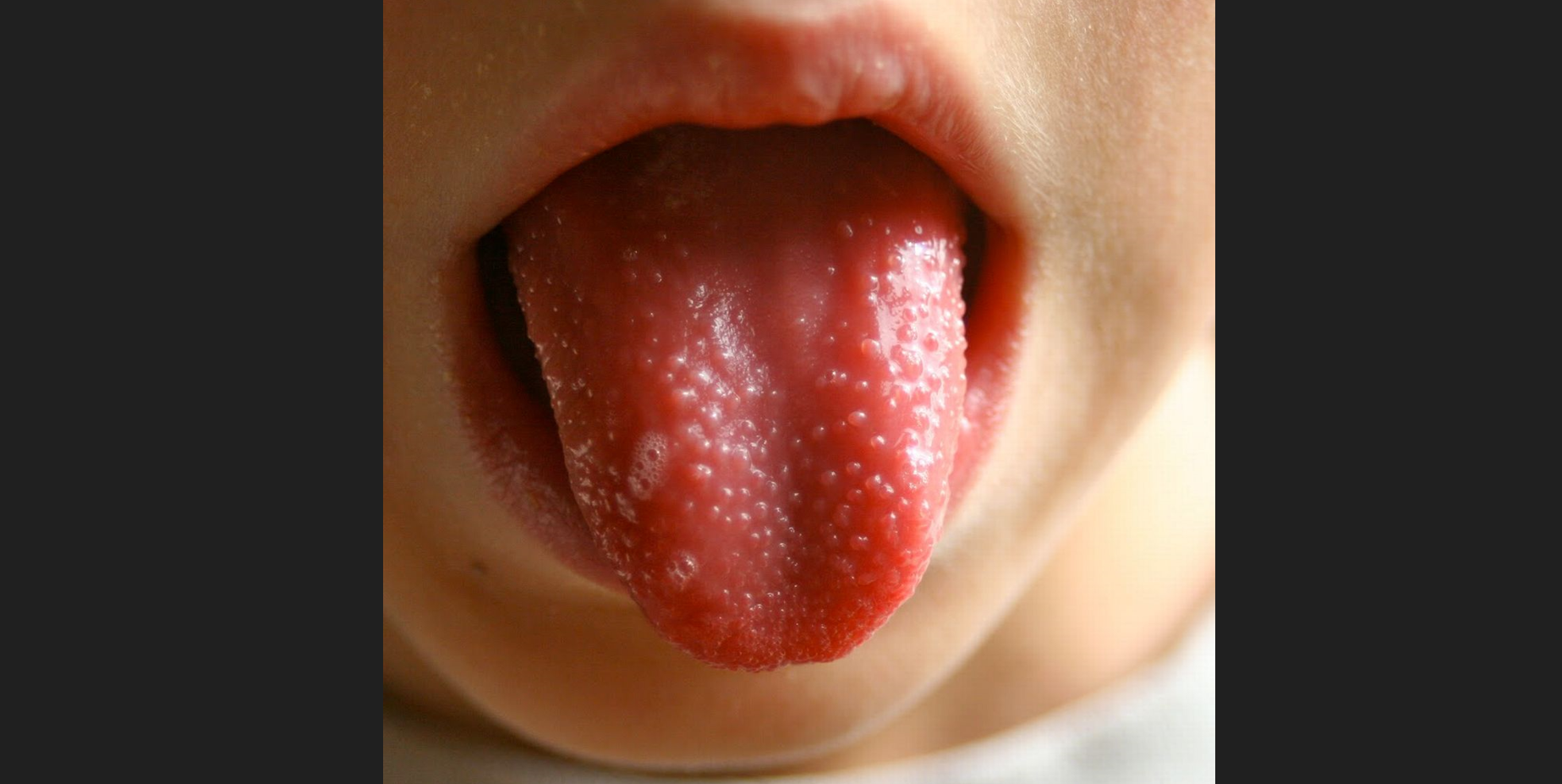 英國爆甲型鏈球菌病例 7名學童死亡 家長恐慌