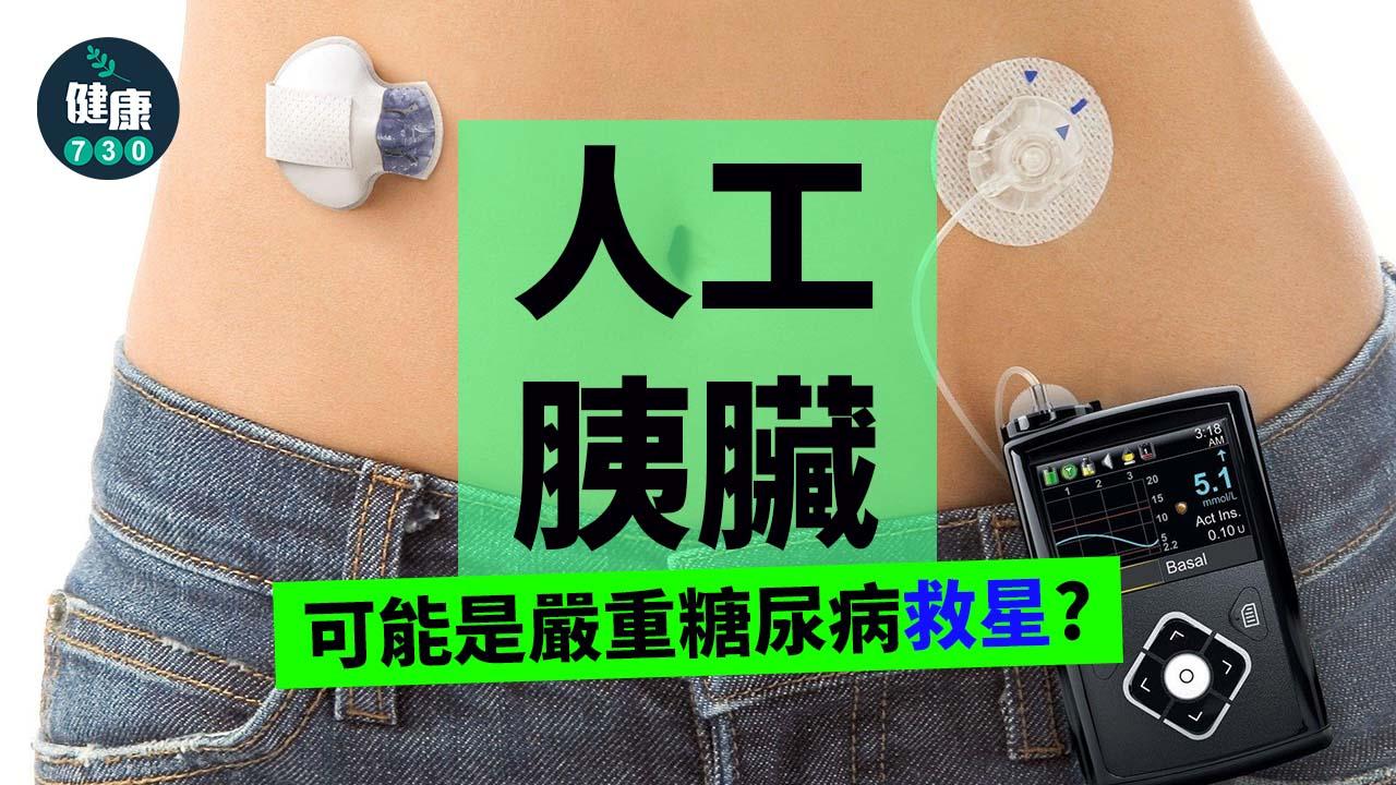 糖尿病｜人工胰臟可能是嚴重糖尿病救星？