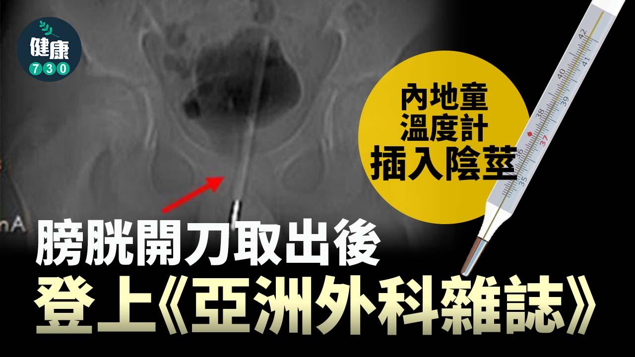 內地童溫度計插入陰莖 膀胱開刀取出後登上《亞洲外科雜誌》