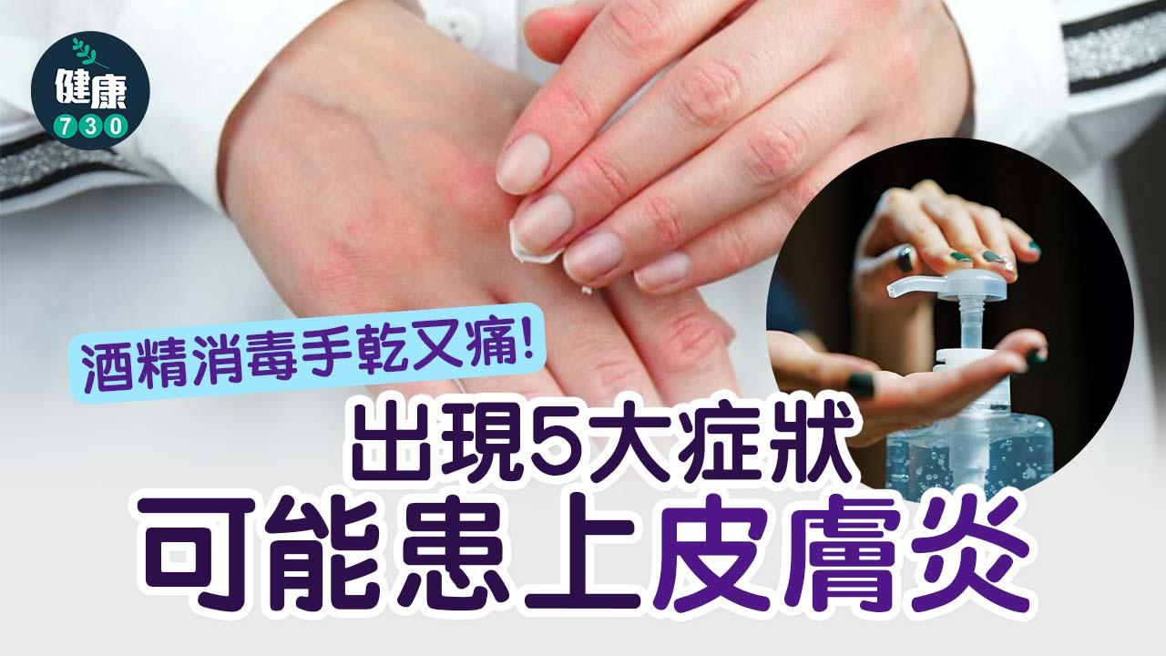 消毒手乾又痛！出現5大症狀可能患上皮膚炎