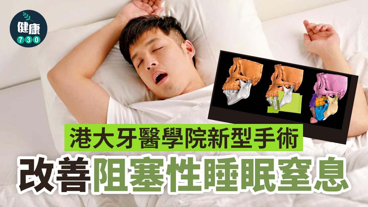 睡眠窒息症｜港大牙醫學院新型手術改善阻塞性睡眠窒息