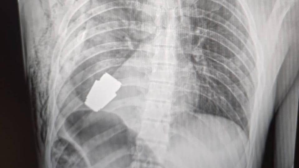 烏傷兵未爆手榴彈卡心藏下方，無用電凝止血奇蹟順利取出。(Twitter)