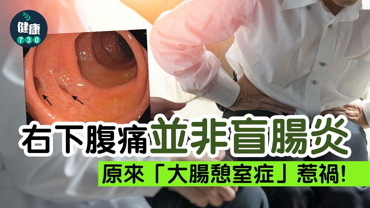 右下腹痛並非盲腸炎 原來「大腸憩室症」惹禍
