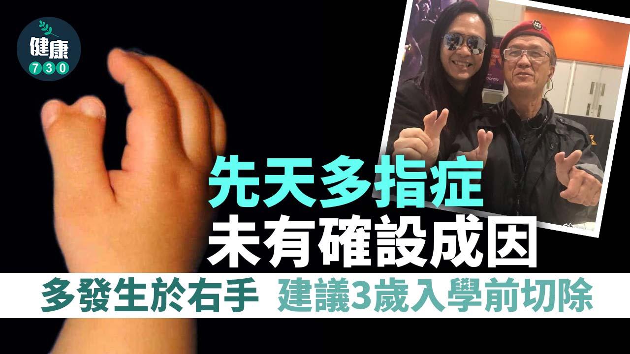 多指症｜先天多指症未有確設成因 建議3歲入學前切除