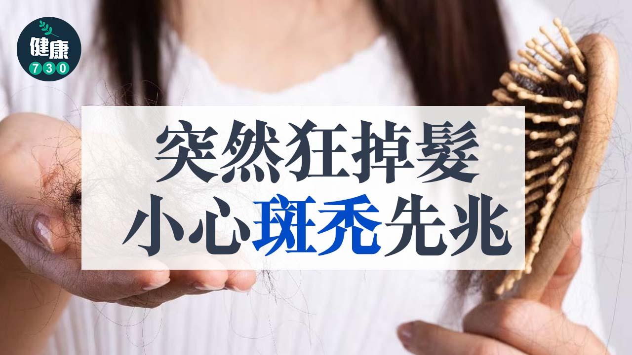 突然狂掉髮 小心斑禿先兆！